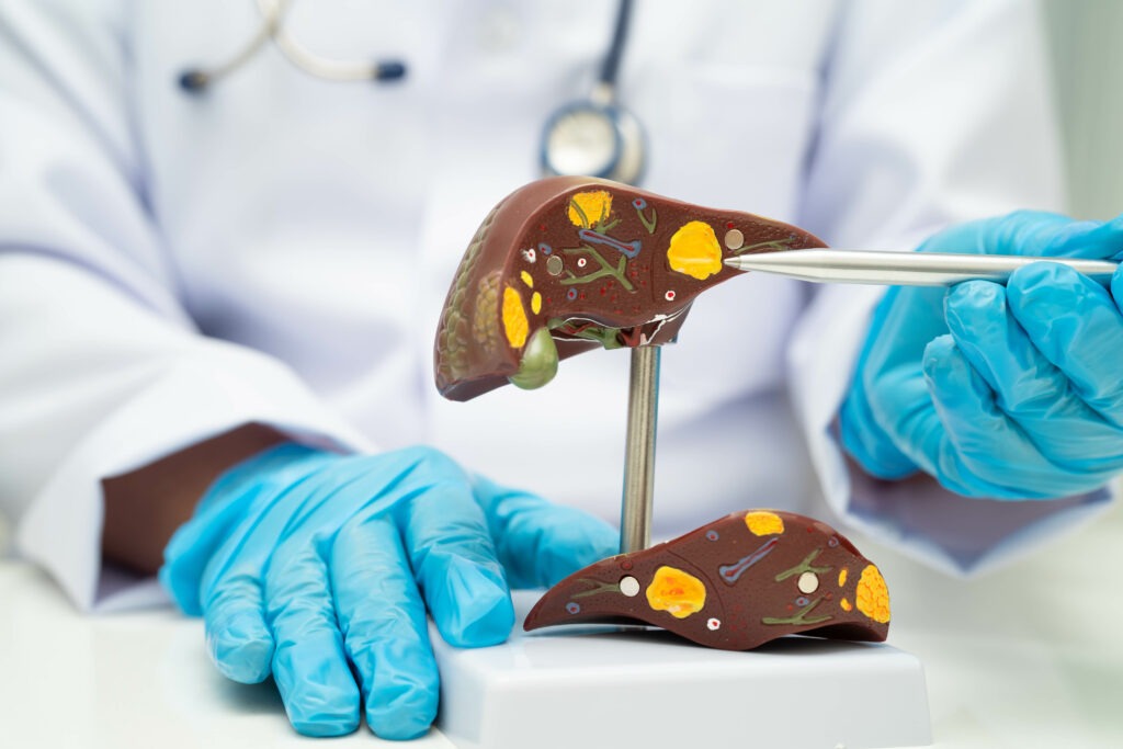 Cirrhosis, Liver Cancer, Fatty Liver, Asian Doctor With Liver Hu